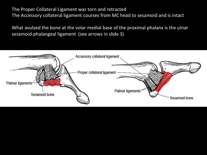 Figure 3 for case ulnar collateral ligament of metacarpophalangeal joint ( RID2336 )